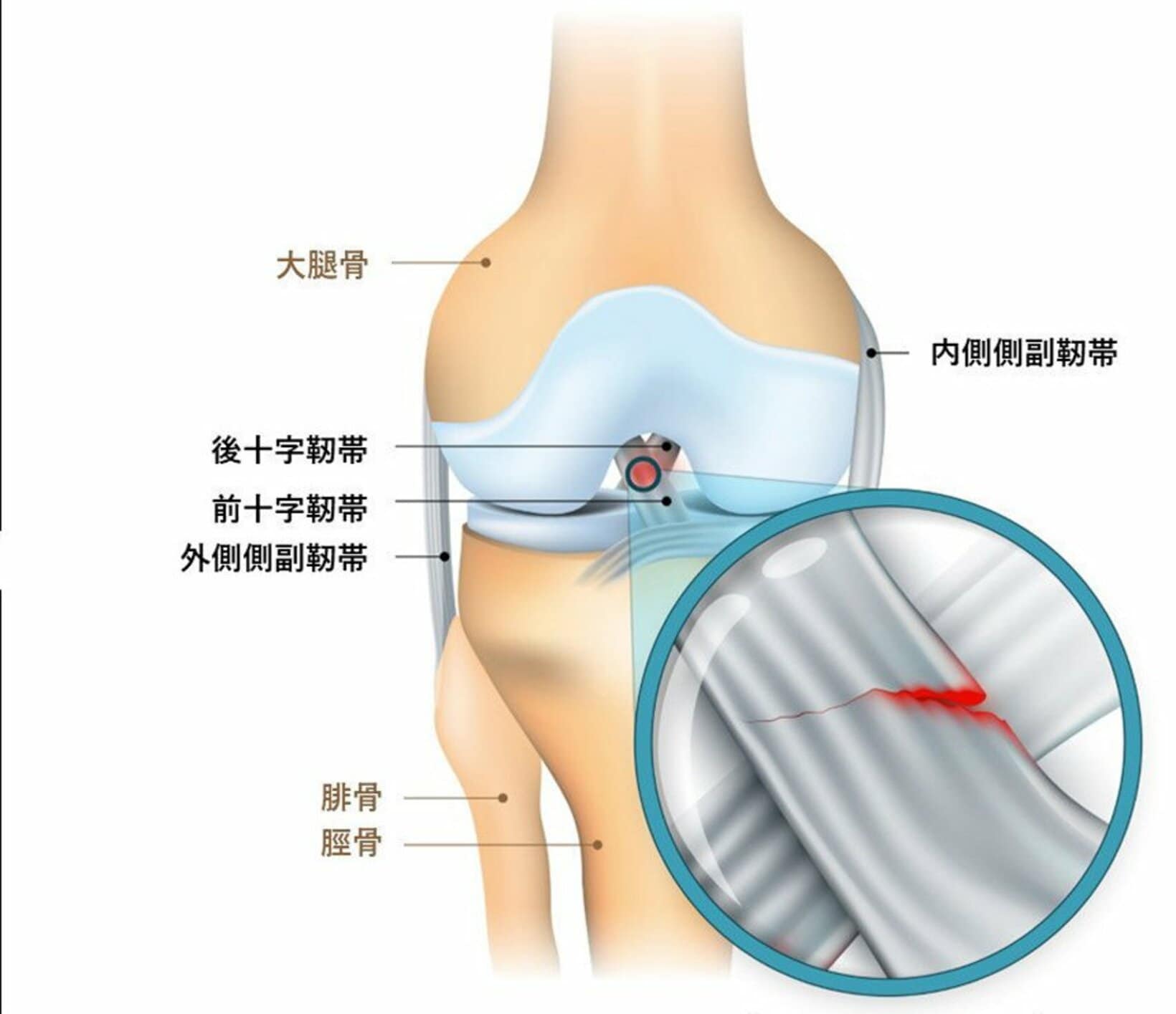 断裂したヒザ前十字靱帯