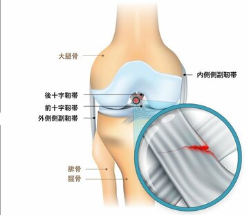 断裂したヒザ前十字靱帯