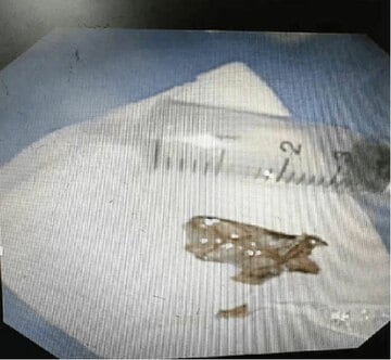 気管から取り除いたゴキブリ（南海網から）