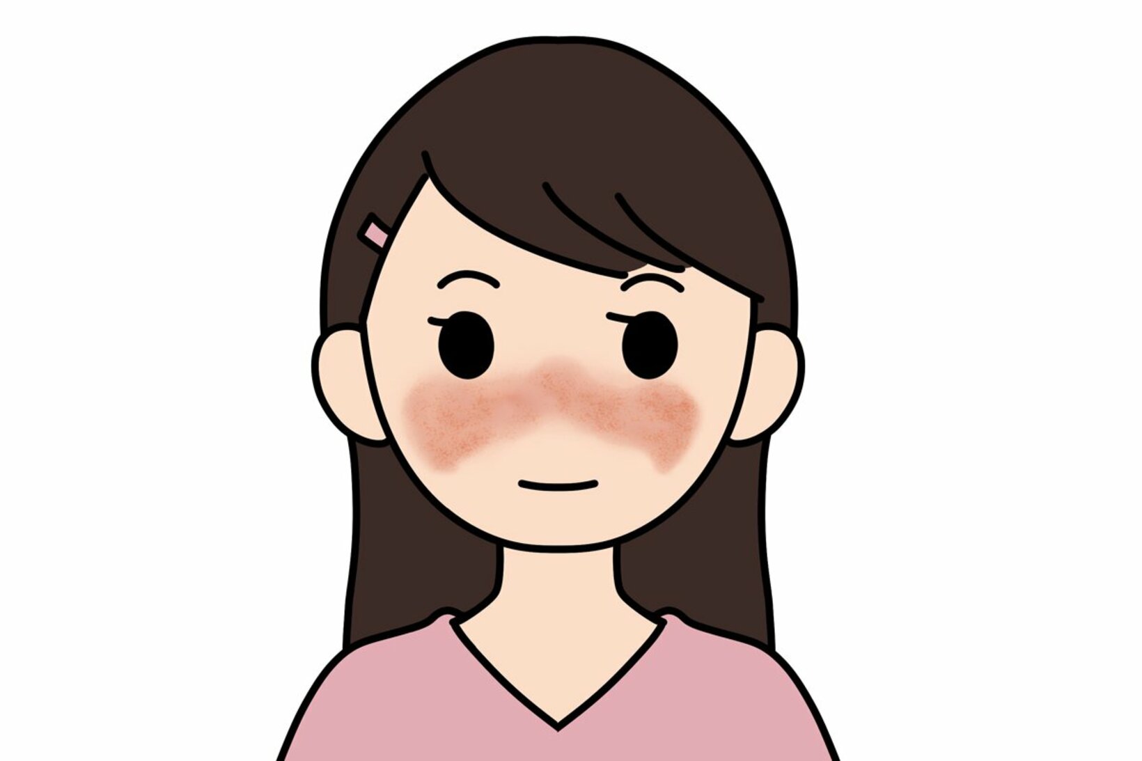 顔に紅斑が出たりするＳＬＥも膠原病の一つだ