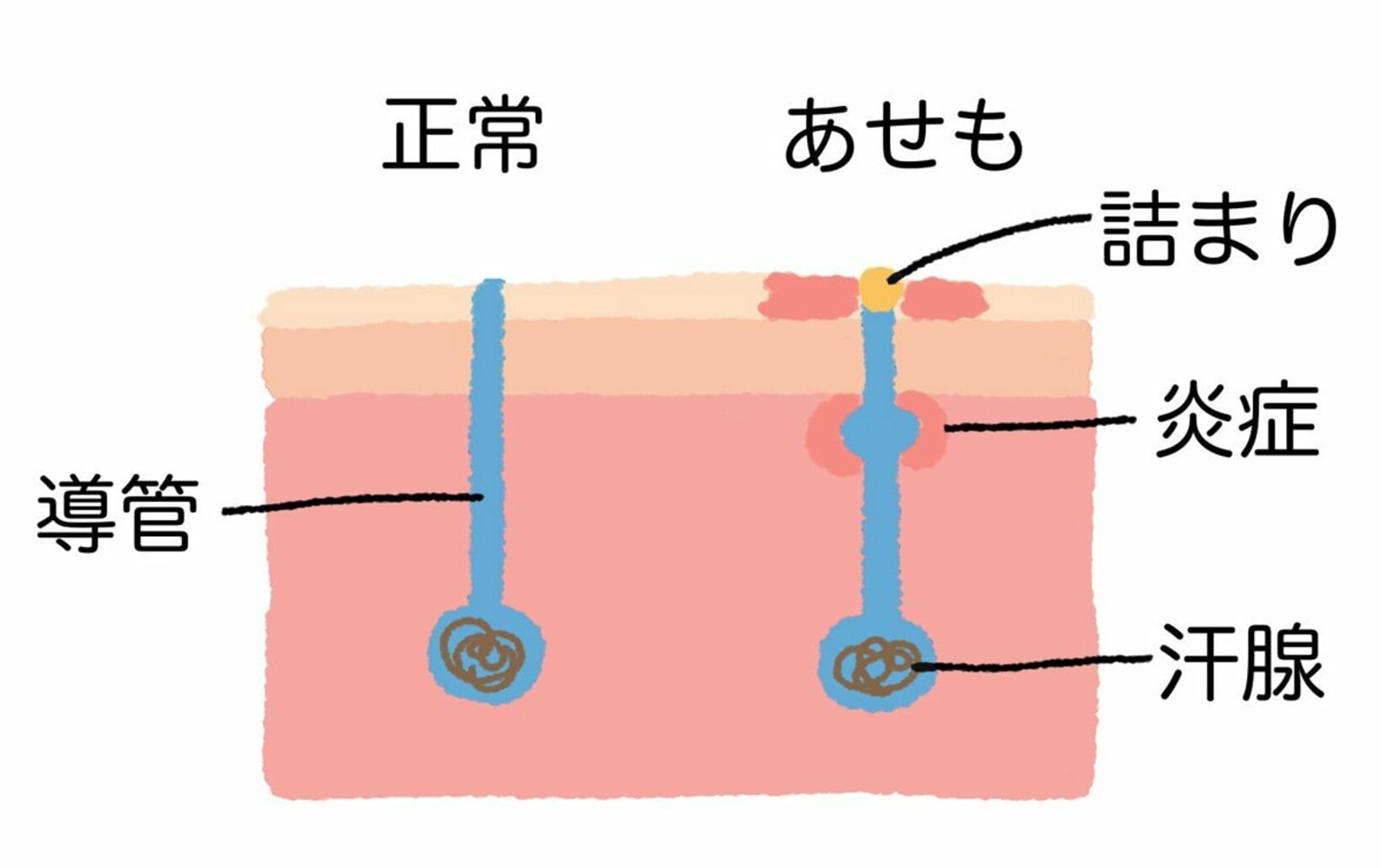 「あせも」とは、汗の出口が詰まってしまう「汗疹」のこと