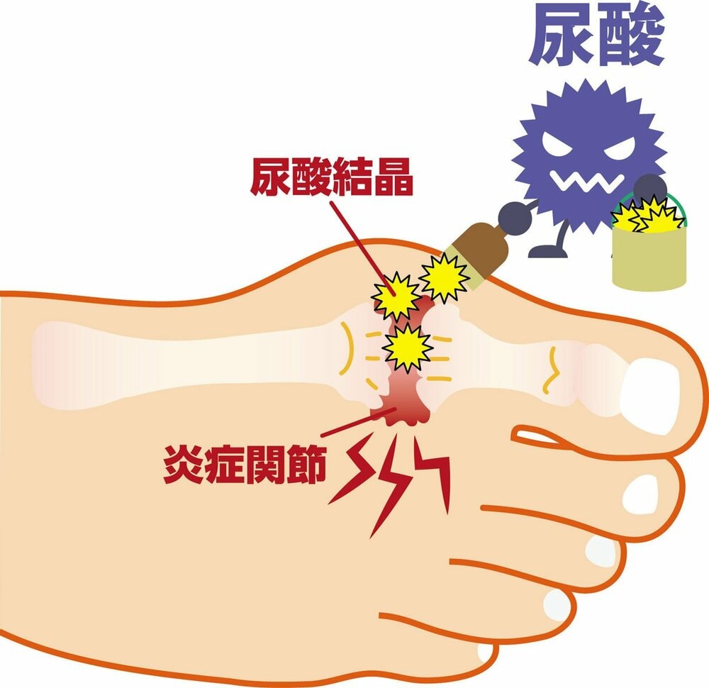 痛風は足の親指の付け根に症状が出ることが多い
