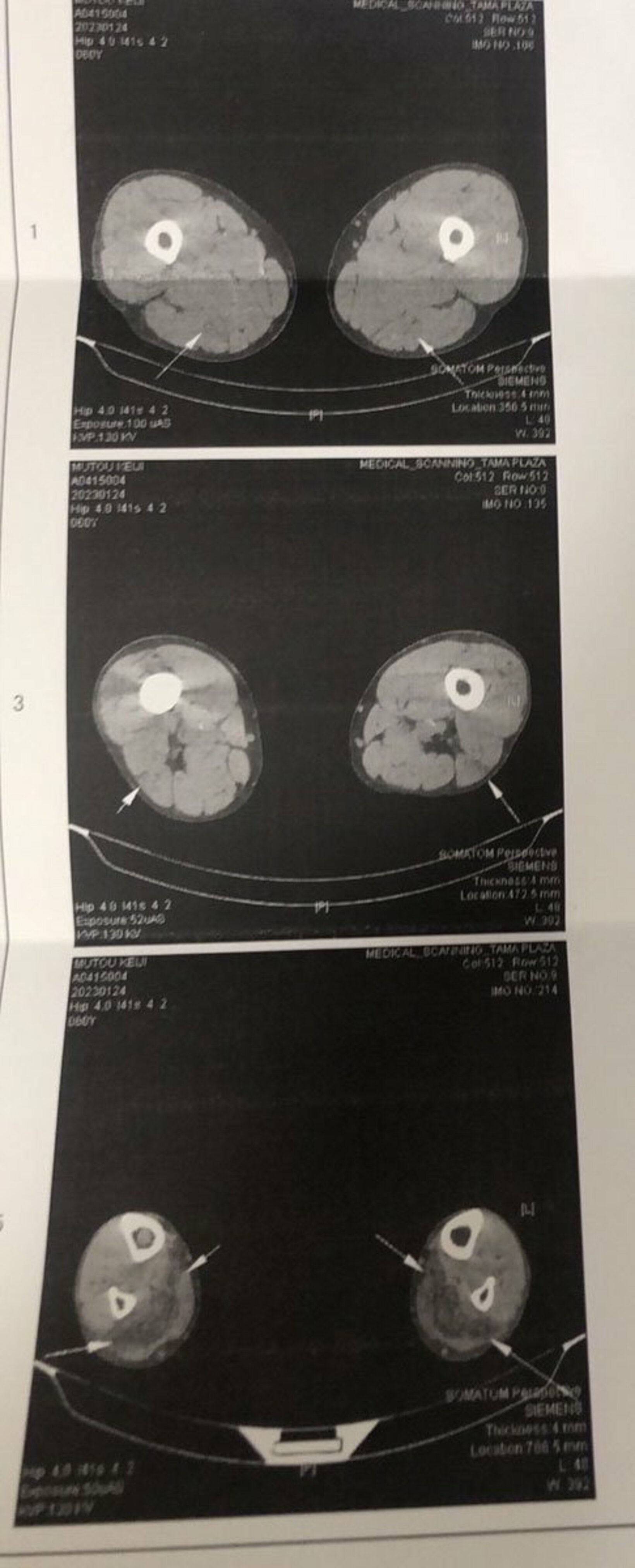 武藤の肉離れのCT画像