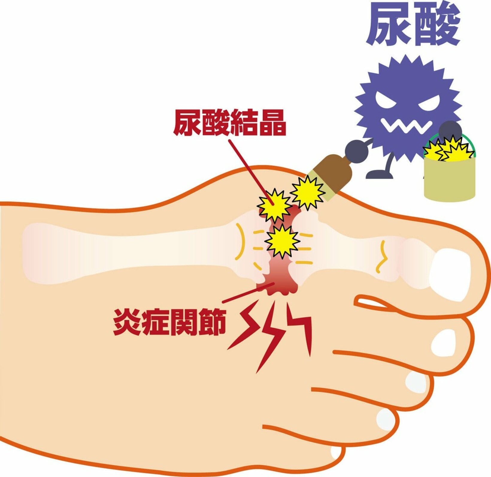 痛風は足の親指の付け根に症状が出ることが多い