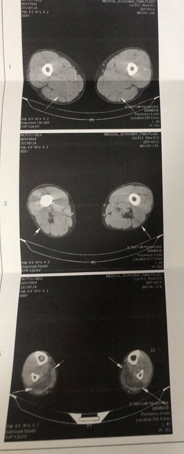 武藤の肉離れのCT画像