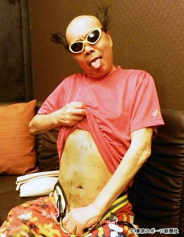  腎臓移植の傷を示す南部虎弾