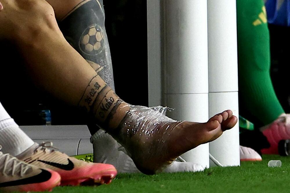 腫れあがったメッシの右足（ロイター）