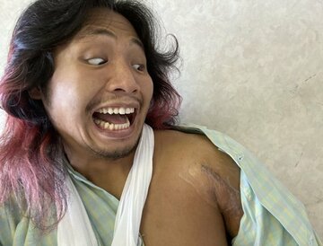  手術を終えたヒロムは左肩の手術痕にこの表情（本人提供）